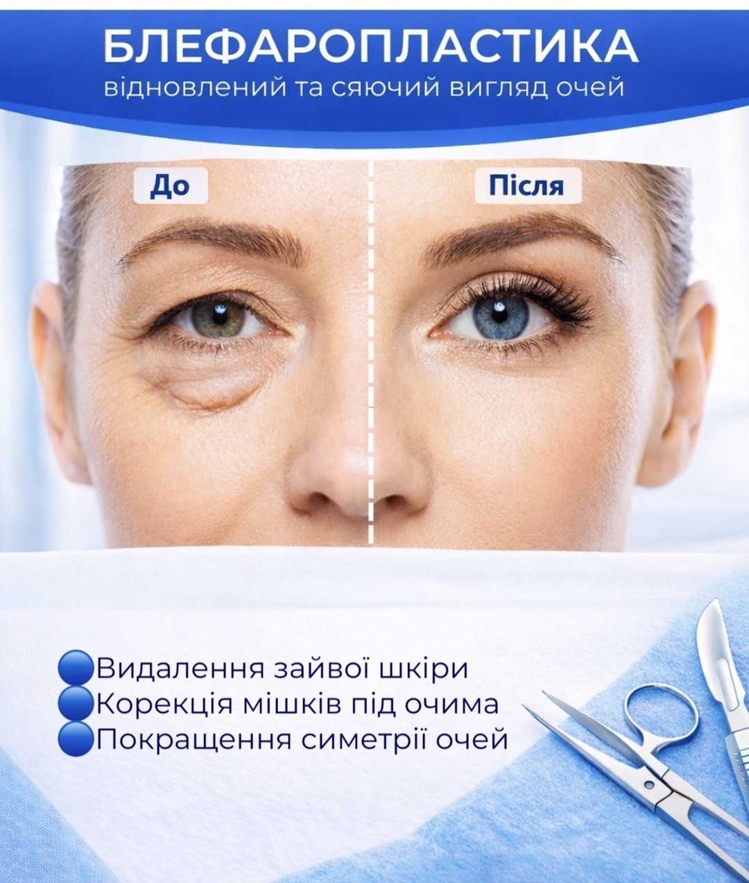 Блефаропластика